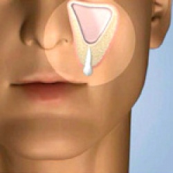 What is a Sinus Lift?