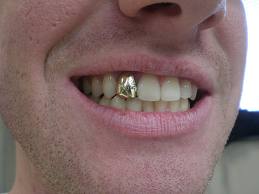 gold-tooth
