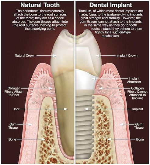 Anatony of dental implant treatment