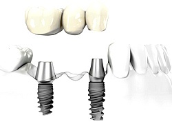 Multiple Dental Implant