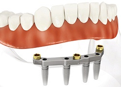 Dentures supported by implants