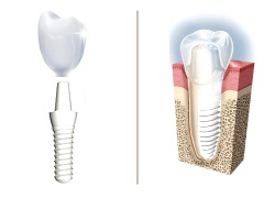 2 'non-metalic' implants 3 metal-free teeth