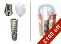 Instant Discount of £100 on Advanced Dental Implants